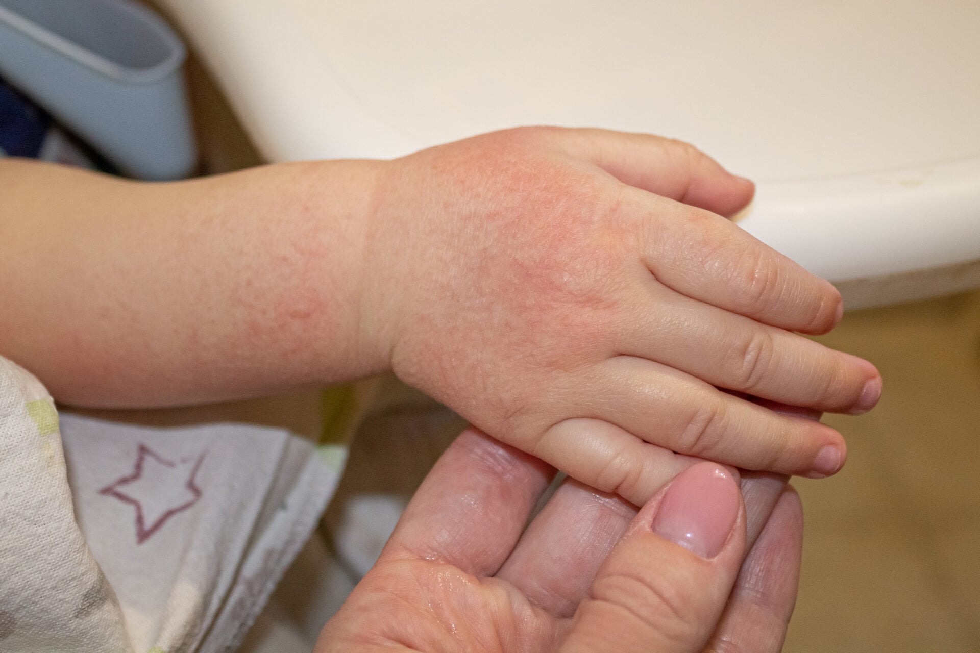 Red spots on the skin of the hands of a child. children's allergy. Dryness and irritation of the skin